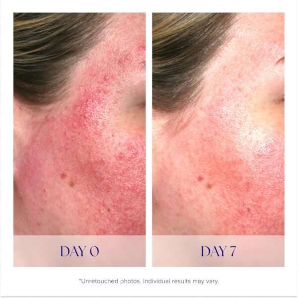 iS CLINICAL Pro-Heal Serum Advance+ - Antioxidant-Rich Vitamin C Serum, Calms Sensitivity & Irritation, Helps Redness, Anti-Aging - Image 5