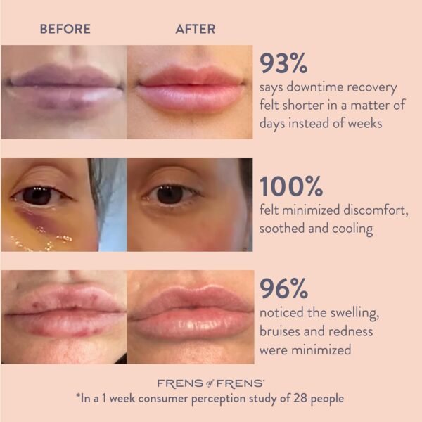 Aesthetic Aftercare | TAKE After CARE Arnica & Bromelain Gel for Bruising, Swelling after Fillers, Cosmetic Injections | Cooling Depuff Serum Face Roller | 100% Vegan (60ml) - Image 4