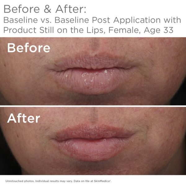 SkinMedica HA5 Smooth & Plump Lip System - Your Hydrating, Volumizing Lip Plumper for Visibly Fuller and Smoother Lips, 0.05 Oz - Image 7