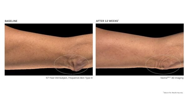 Revision Skincare BodiContour™, Contouring Body Lotion with iFirm® Technology, Firms, Tightens & Lifts Sagging, Crepey Skin, Enhances Results with Body Contouring & Weight Loss Medications - Image 6