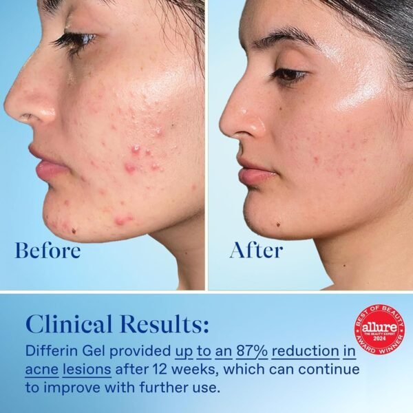 Differin Acne Treatment Gel, 90 Day Supply, Retinoid Treatment for Face with 0.1% Adapalene, Gentle Skin Care for Acne Prone Sensitive Skin, 45g Pump (Packaging May Vary) - Image 9