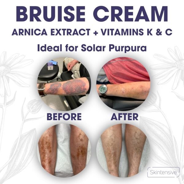 SKINTENSIVE Arnica Bruise Cream for Thin Skin - Moisturizing, Vitamin K C and E, Skin Renewal, 4 Oz - Image 6