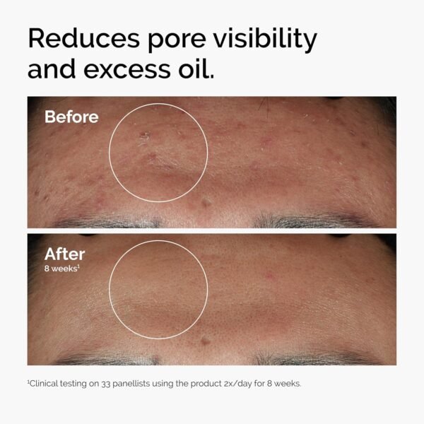 The Ordinary Niacinamide 10% + Zinc 1%, Smoothing Serum for Blemish-Prone Skin - Image 3